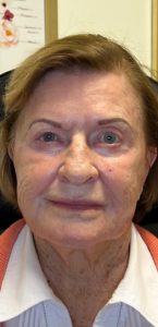 Before Image: Sculptra