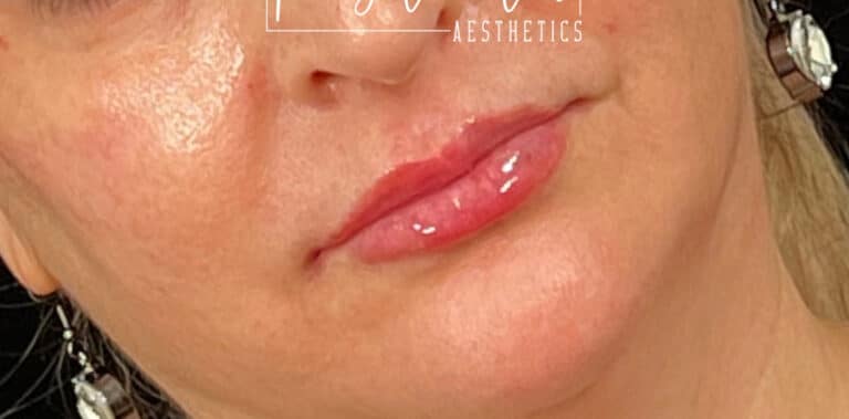 After Image: Lip Filler - right-front-oblique