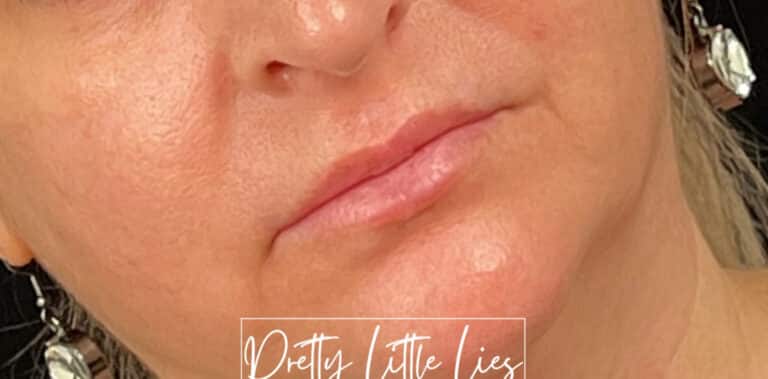 Before Image: Lip Filler - right-front-oblique