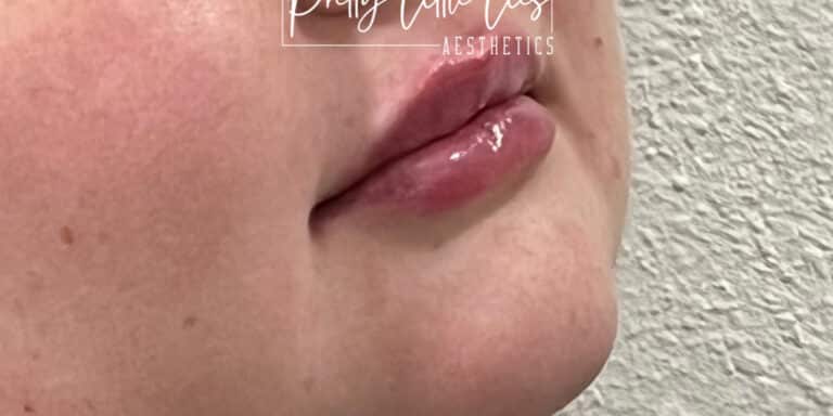 After Image: Lip Filler - right-front-oblique