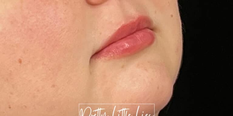 Before Image: Lip Filler - right-front-oblique