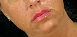 After Image: Lip Filler