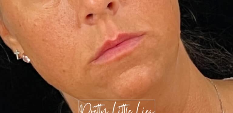 Before Image: Lip Filler - right-front-oblique