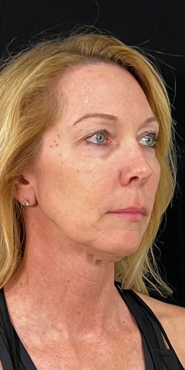 After Image: Full Face Filler - right-front-oblique