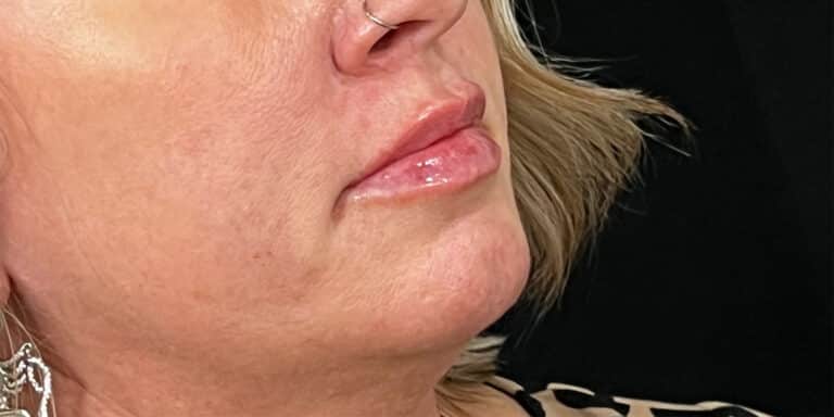 After Image: Lip Filler - right-front-oblique