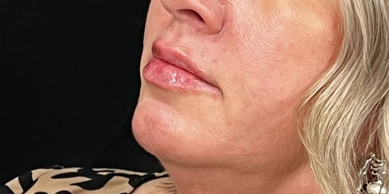 After Image: Lip Filler - left-front-oblique