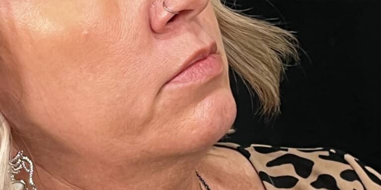 Before Image: Lip Filler - right-front-oblique