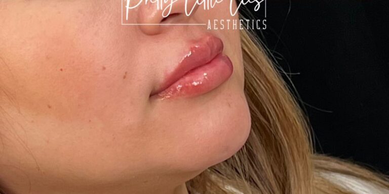 After Image: Lip Filler - right-front-oblique