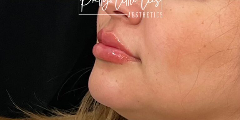 After Image: Lip Filler - left-front-oblique