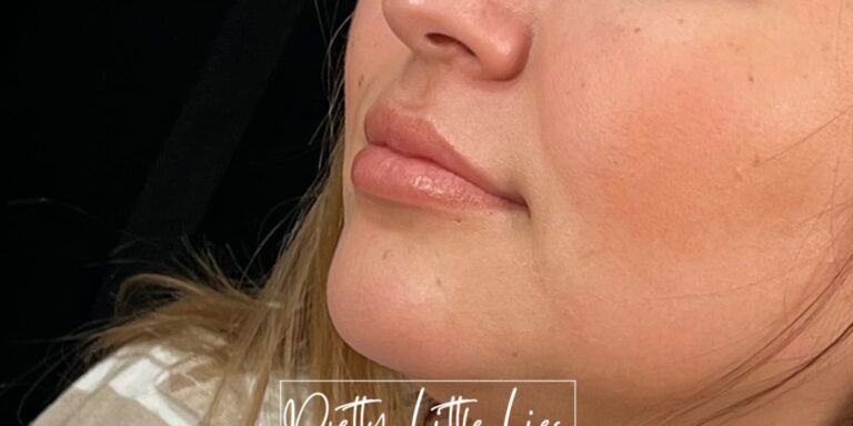 Before Image: Lip Filler - left-front-oblique