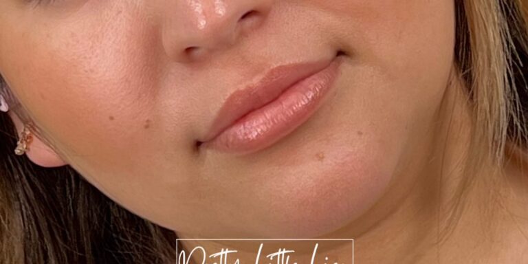 Before Image: Lip Filler - right-front-oblique