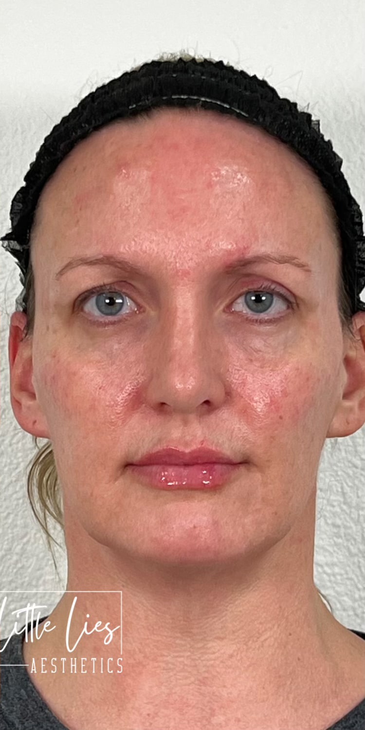 After Image: Full Face Filler - front