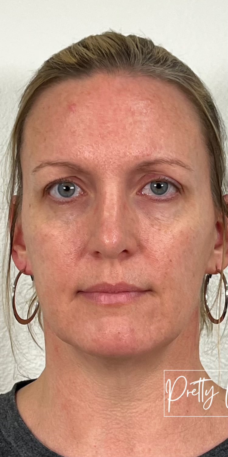 Before Image: Full Face Filler - front