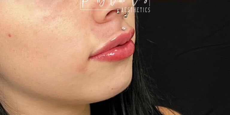 After Image: Lip Filler - right-front-oblique