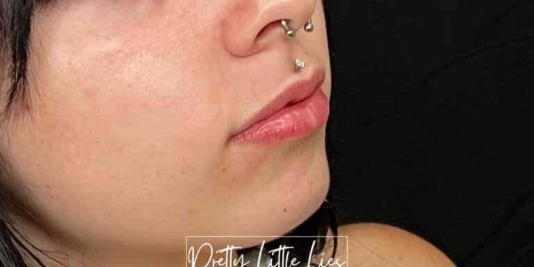 Before Image: Lip Filler - right-front-oblique