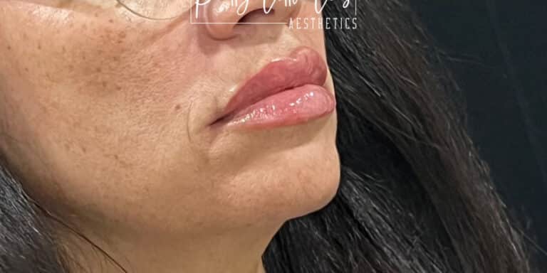 After Image: Lip Filler - right-front-oblique