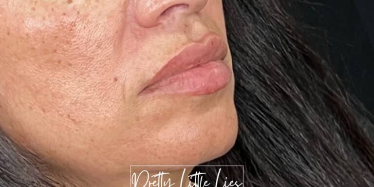 Before Image: Lip Filler - right-front-oblique