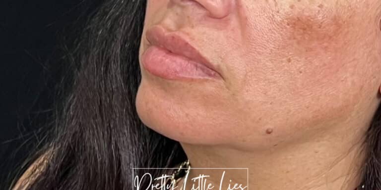 Before Image: Lip Filler - left-front-oblique