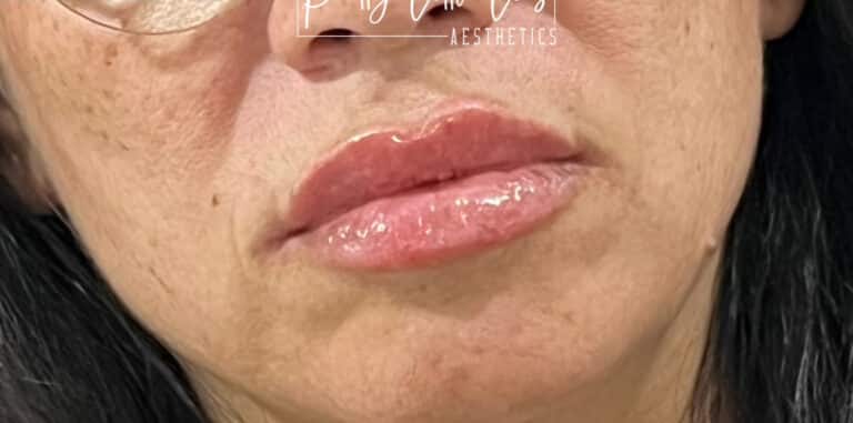 After Image: Lip Filler - right-front-oblique