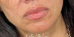 Before Image: Lip Filler