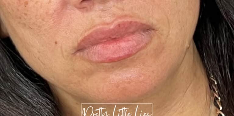 Before Image: Lip Filler - right-front-oblique