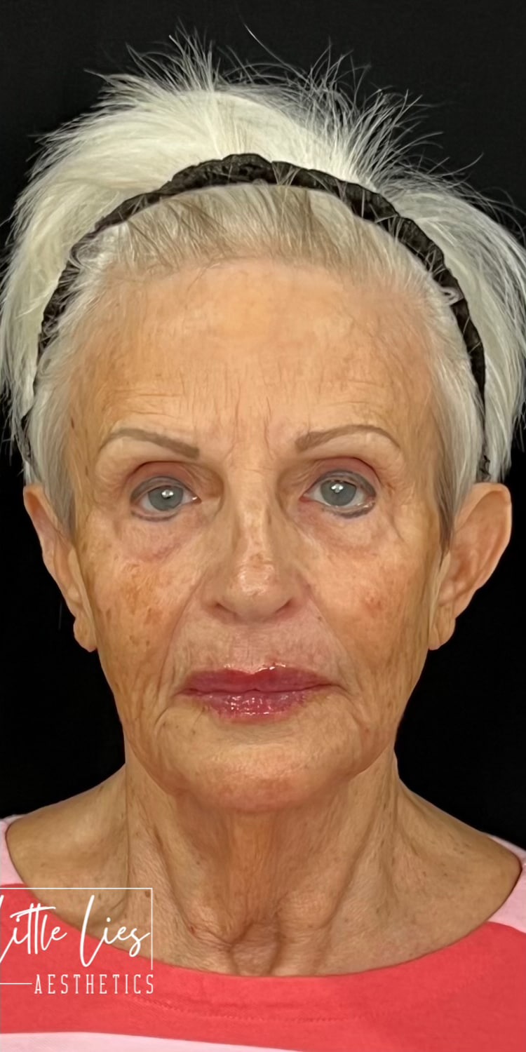 After Image: Full Face Filler - front