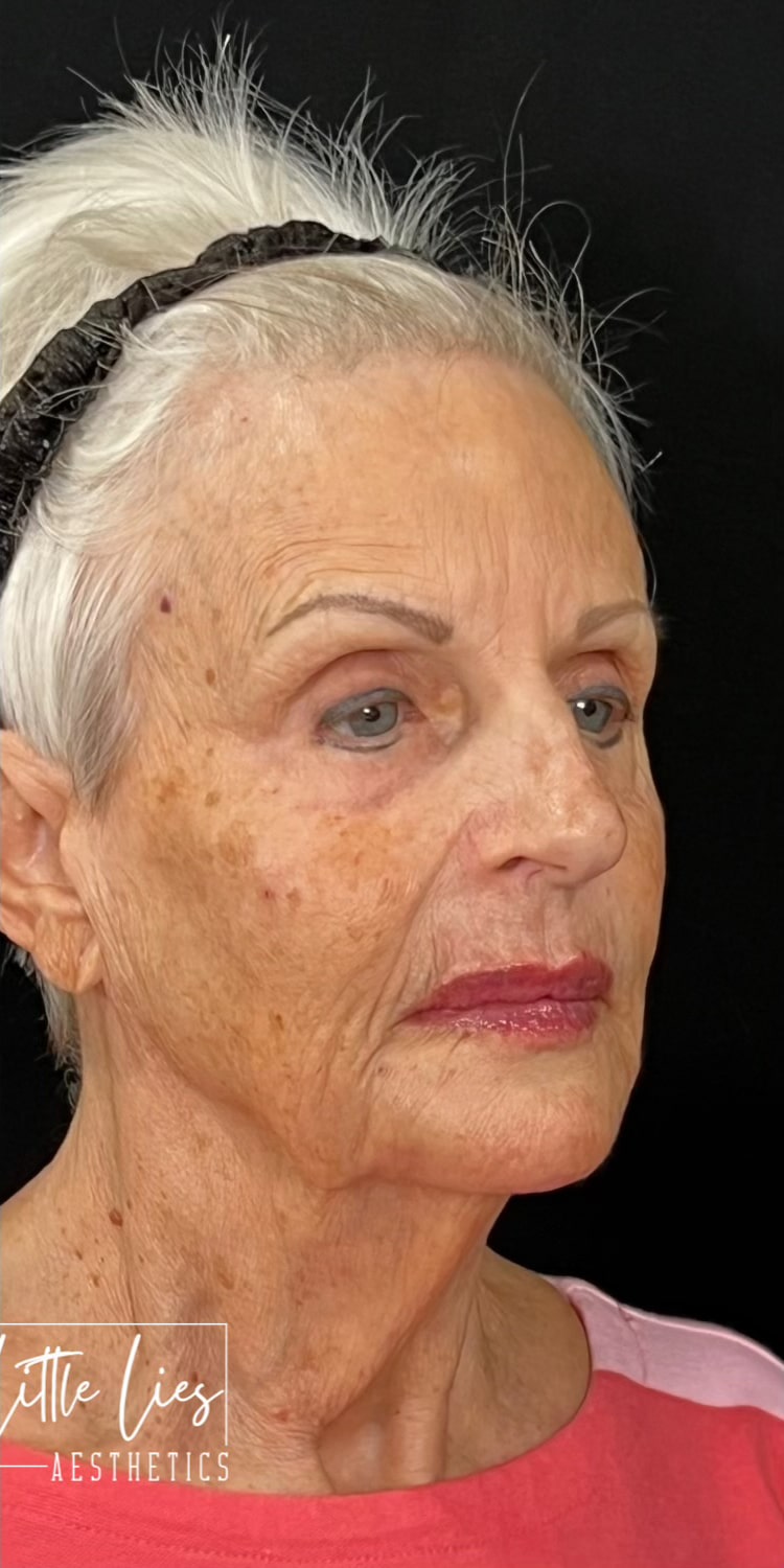 After Image: Full Face Filler - right-front-oblique