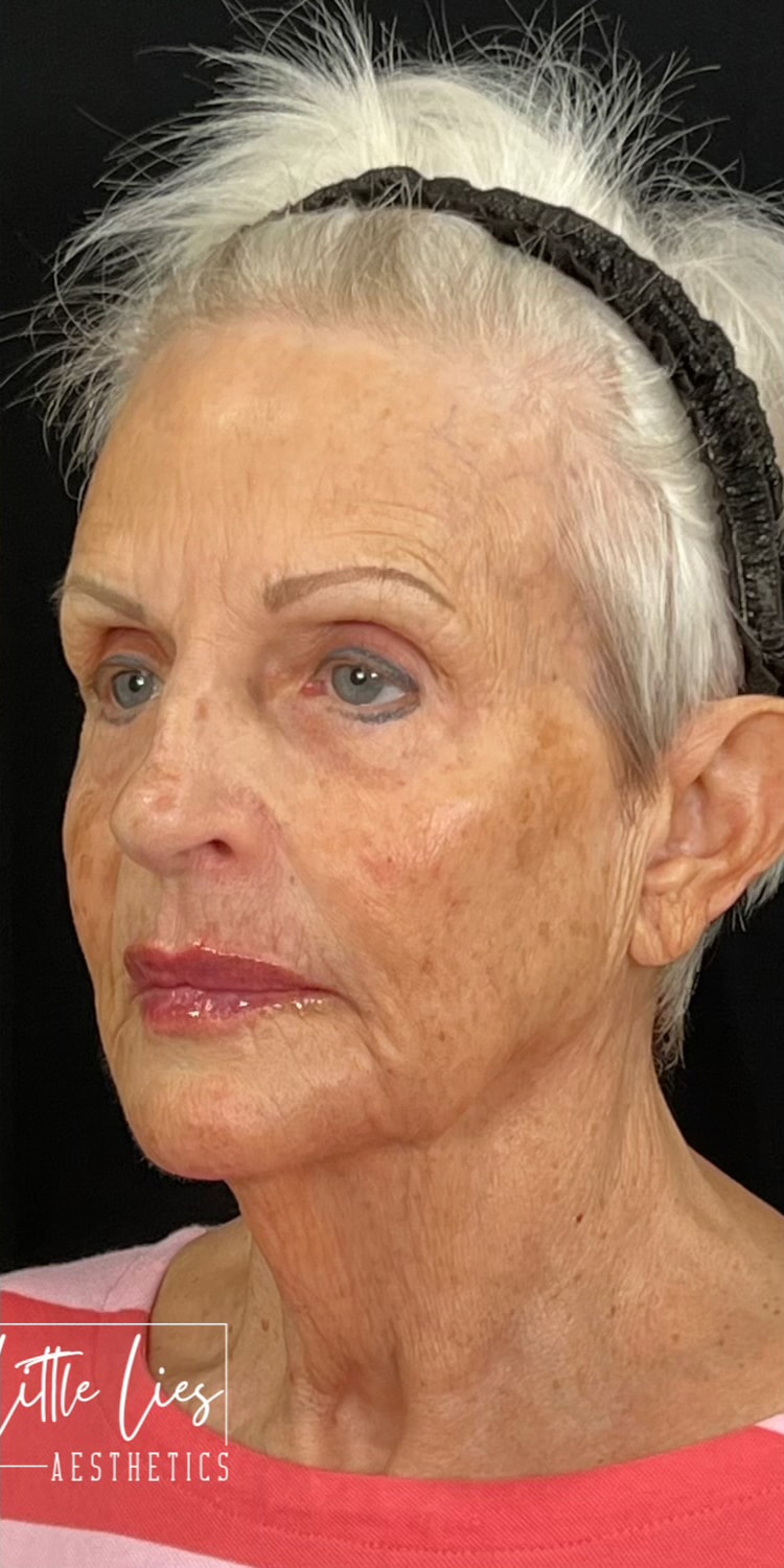 After Image: Full Face Filler - left-front-oblique