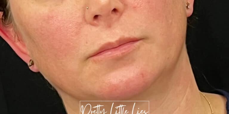 Before Image: Lip Filler - right-front-oblique